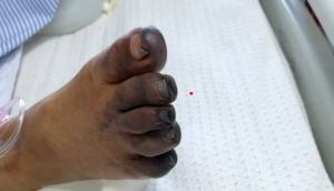 пальці стопи з гангреною, ураження тканин, анаеробна інфекція